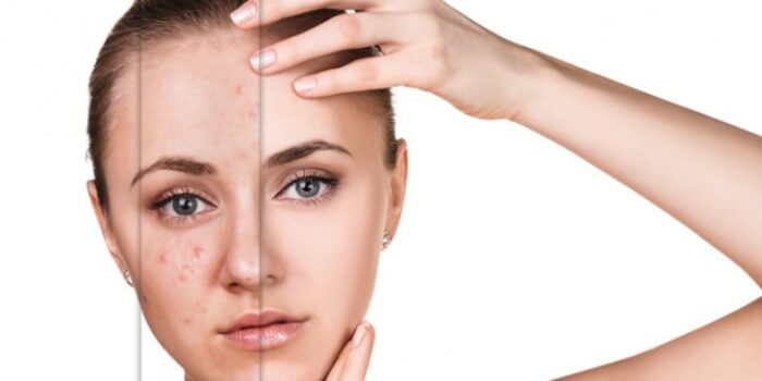 Bintik Gelap di Kulit Wajah, Apa Itu Freckles? – Gaya