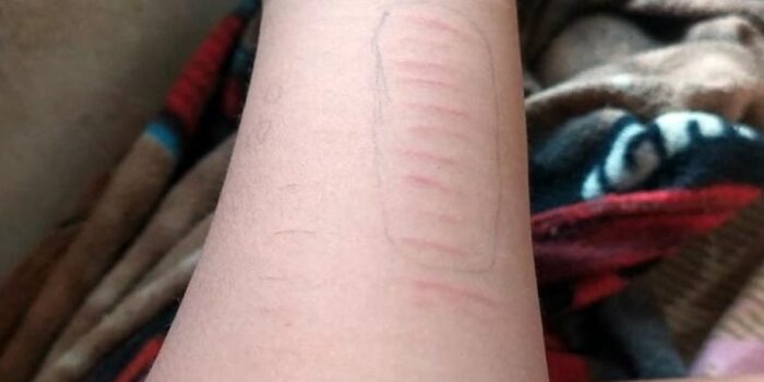 Siswa SD di Situbondo yang Ikutan Tren Viral Sayat Tangan Mendapatkan Alat dari Pedagang Keliling – Berita Jatim