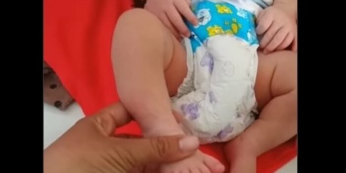 Viral Bayi Perempuan di Sampang Miliki 24 Jari – Berita Jatim