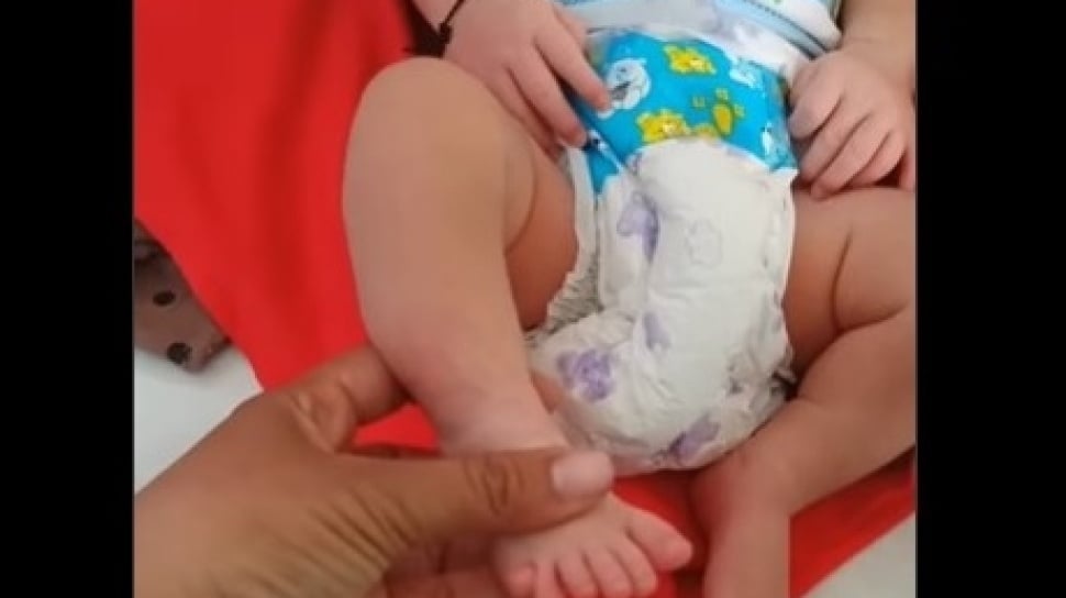Viral Bayi Perempuan di Sampang Miliki 24 Jari