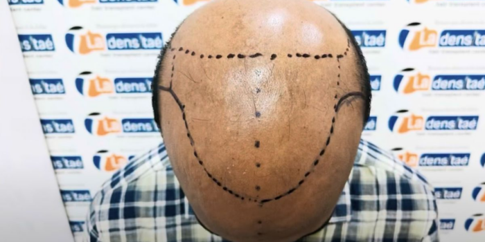 Berita Ide Gila! Pria India Jual Jasa Pasang Iklan di Kepala Botak