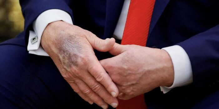 Berita Trump Lagi-lagi Muncul di Publik dengan Tangan Memar, Sakit Apa?