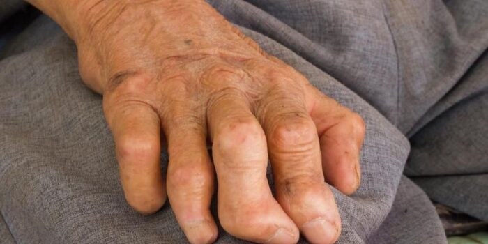 Berita Kemenkes Respons WNI Jadi Kasus Pertama Kusta di Rumania Usai 44 Tahun