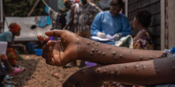 Berita Status Darurat Mpox Dicabut, Afrika Masuki Fase Eliminasi Berita Status Darurat Mpox Dicabut, Afrika Masuki Fase Eliminasi